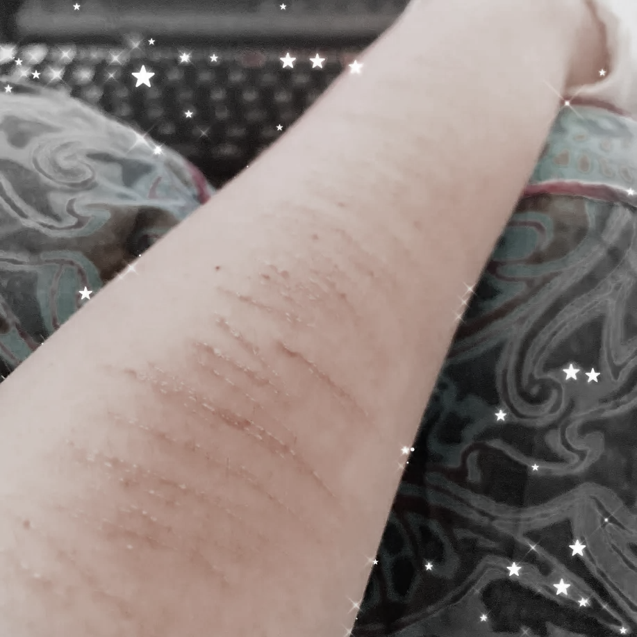 almost healed marks
